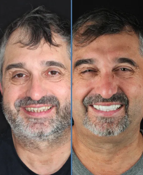 Antes e depois (1)