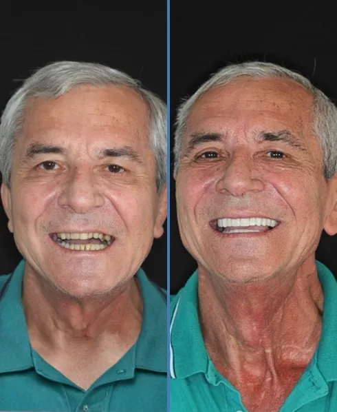 Antes e depois (3) (1)